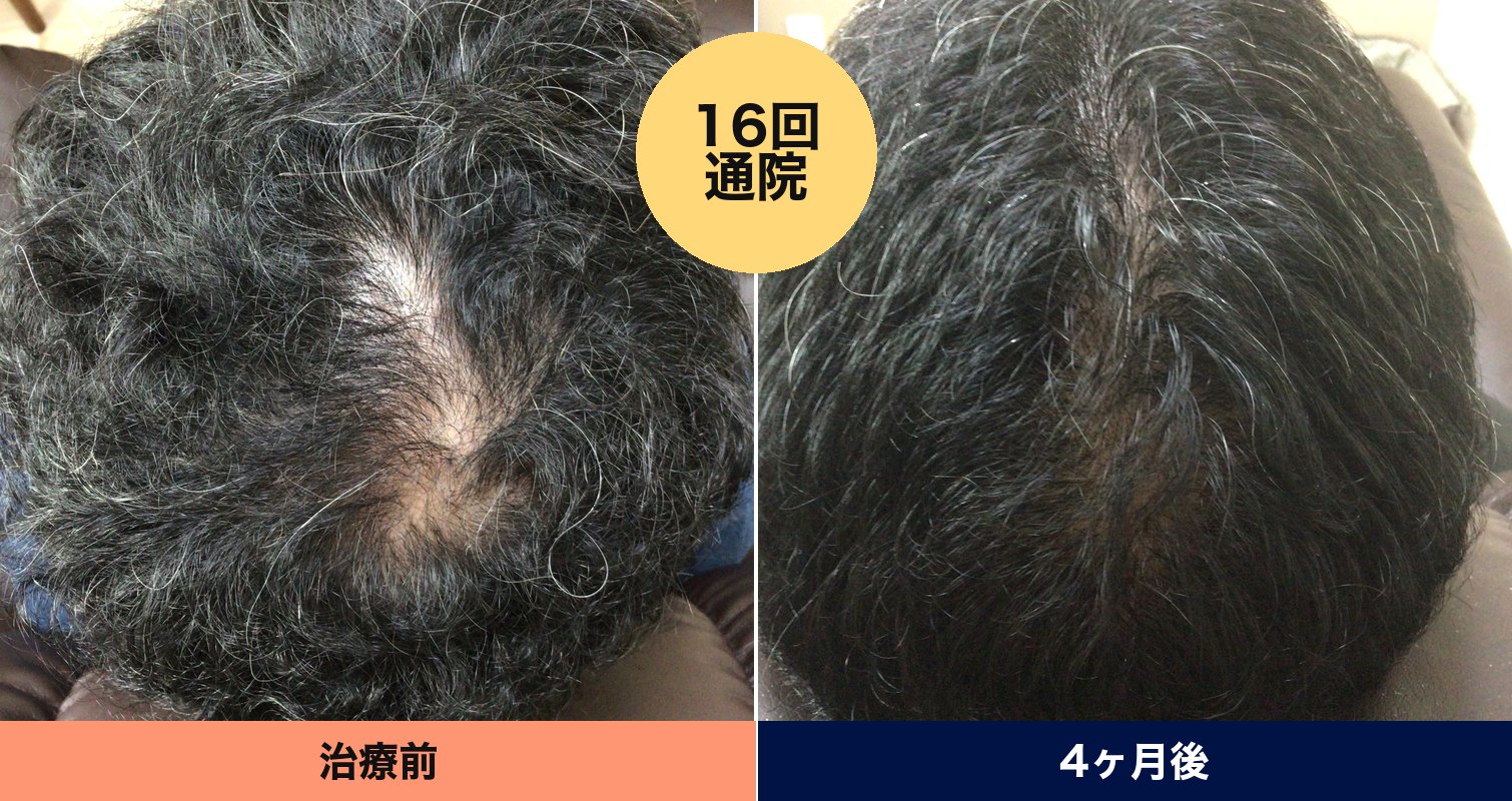 40代男性 4ヶ月（16回通院） 施術前と施術後の頭頂部