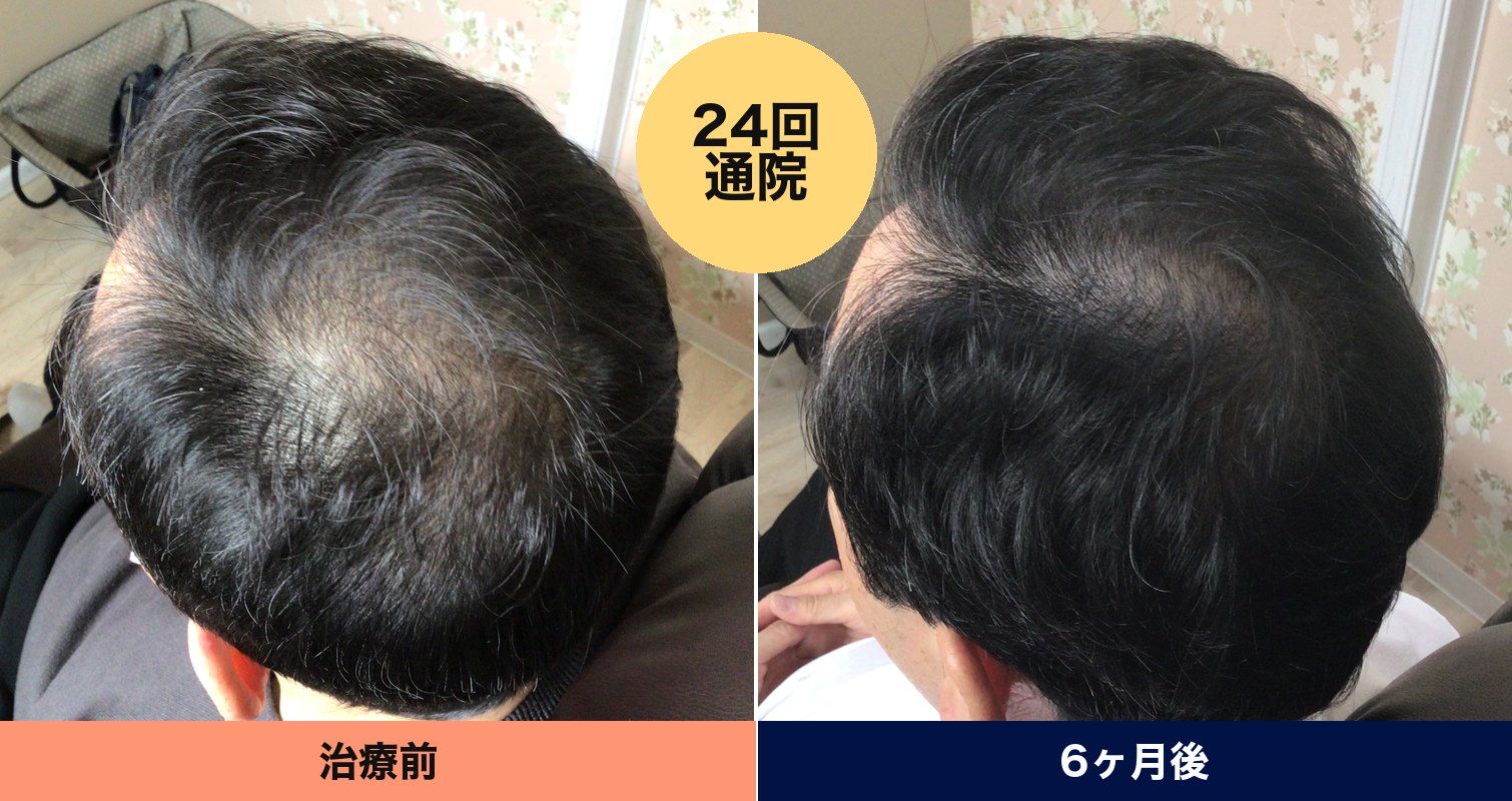 60代男性 6ヶ月（24回通院） 施術前と施術後の頭頂部