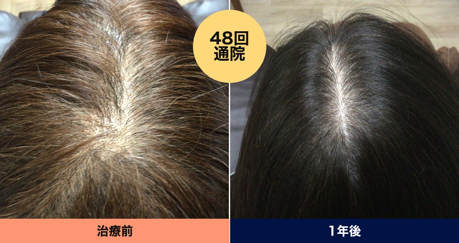 50代女性 1年（48回通院） 施術前と施術後の頭頂部