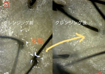 choonpa 超音波頭皮洗浄